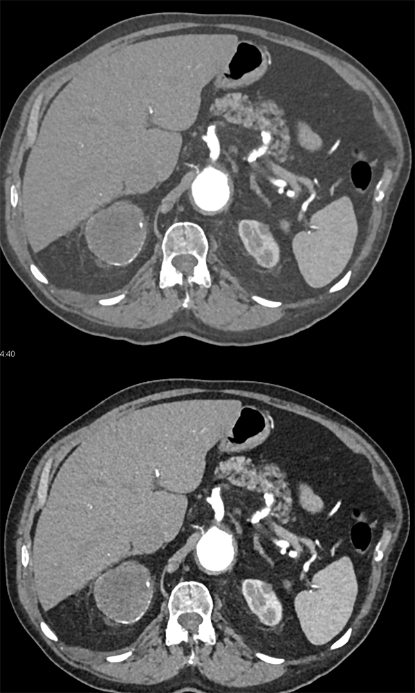 Old Adrenal Hematoma