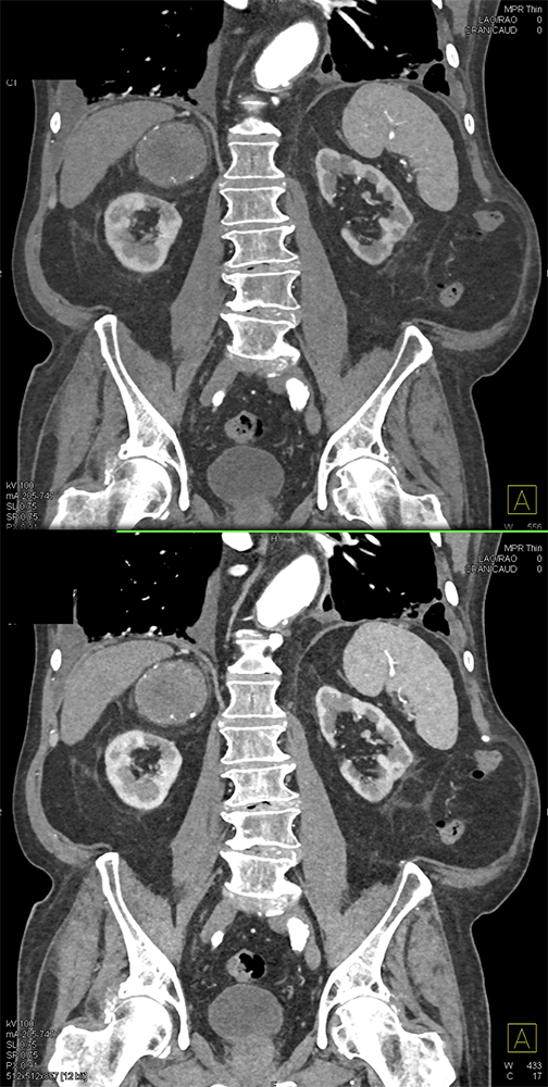 Large Adrenal Masses