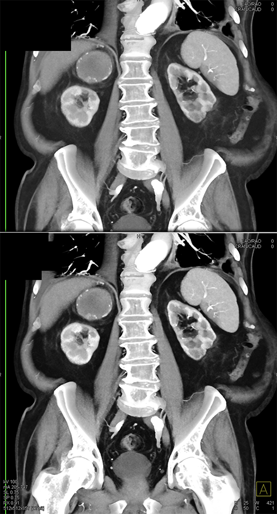 Large Adrenal Masses