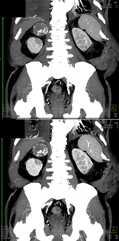 Large Adrenal Masses