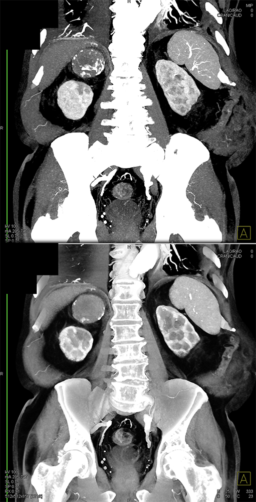 Large Adrenal Masses