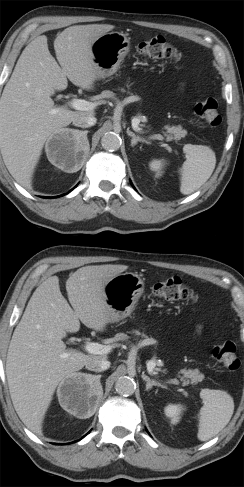 Old Adrenal Hematoma