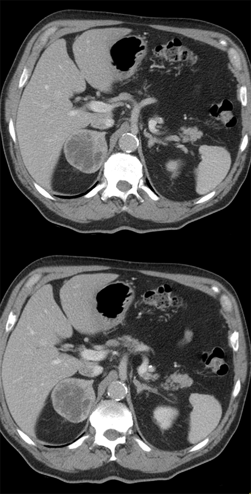 Large Adrenal Masses