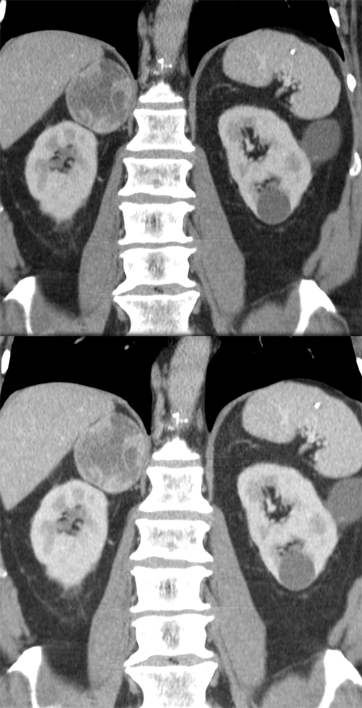 Large Adrenal Masses