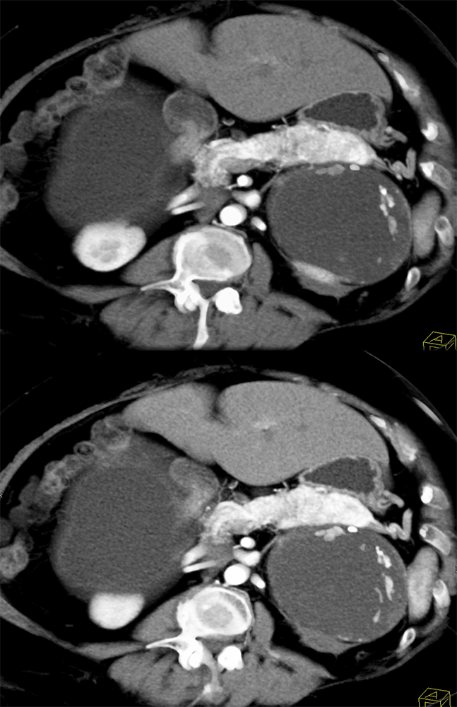 Large Adrenal Masses