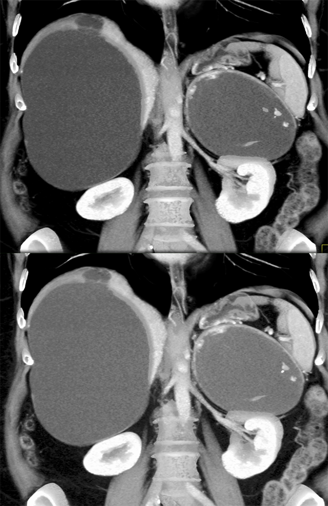 Large Adrenal Masses