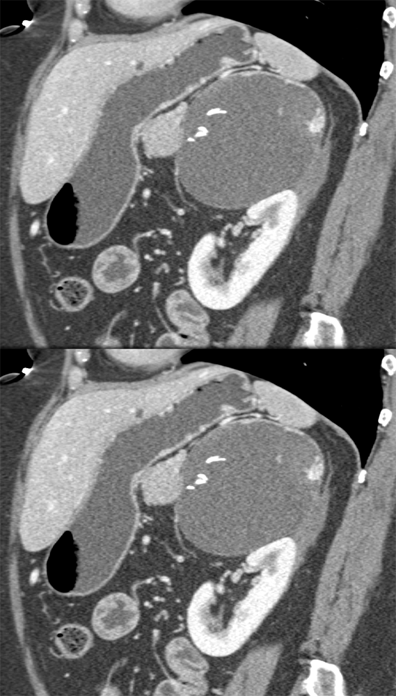 Large Adrenal Masses