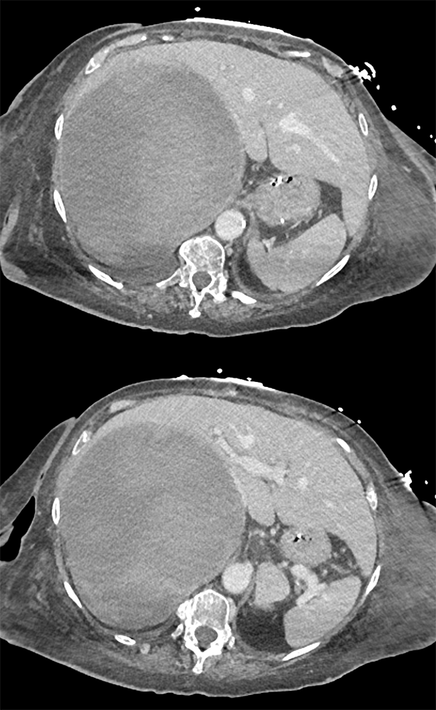 Large Adrenal Masses