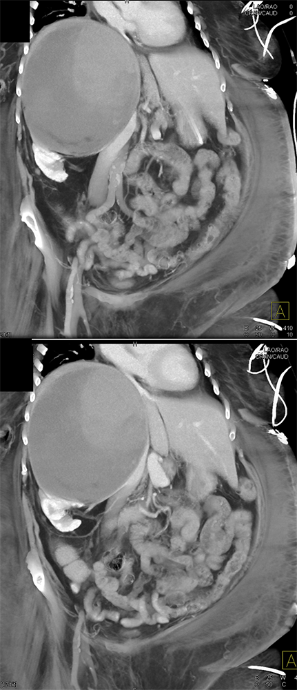 Large Adrenal Masses