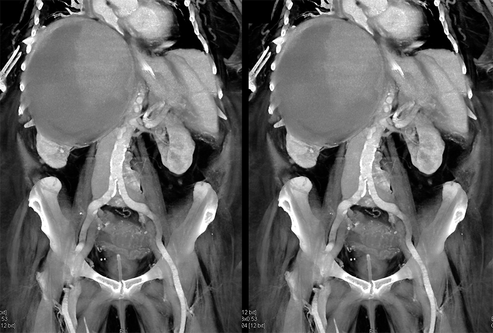 Large Adrenal Masses