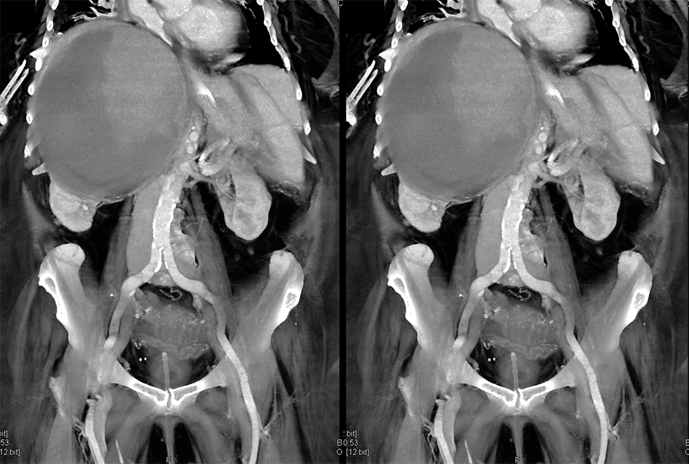 Large Adrenal Masses