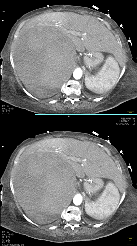 Adrenal Bleed with Benign Mass (adenoma)