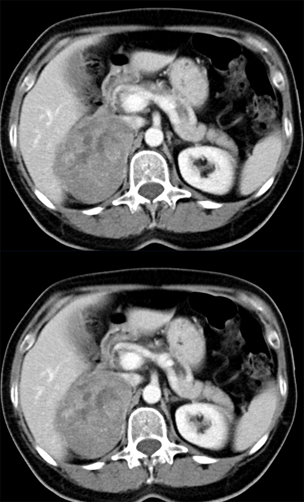 Large Adrenal Masses