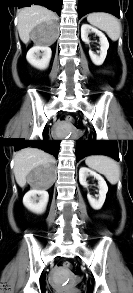 Large Adrenal Masses