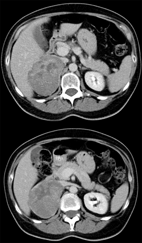 Large Adrenal Masses