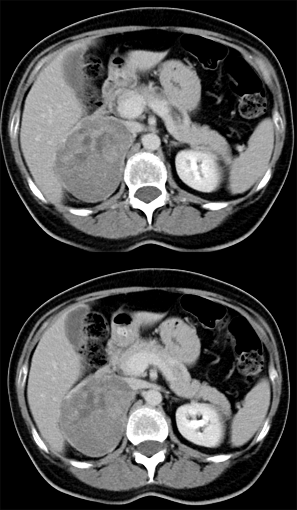 Large Adrenal Masses