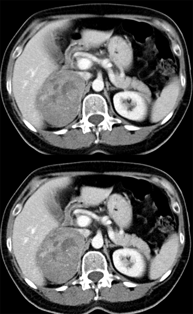 Bleed in a Pheochromocytoma