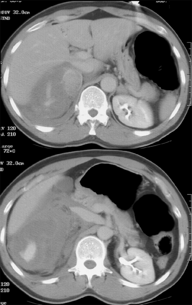 Large Adrenal Masses