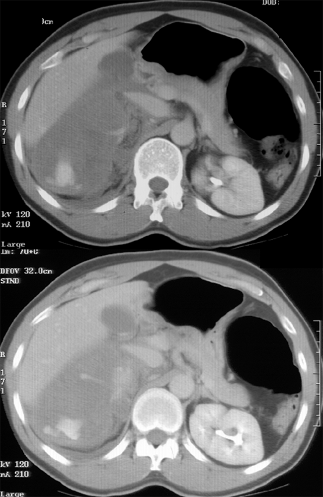 Large Adrenal Masses