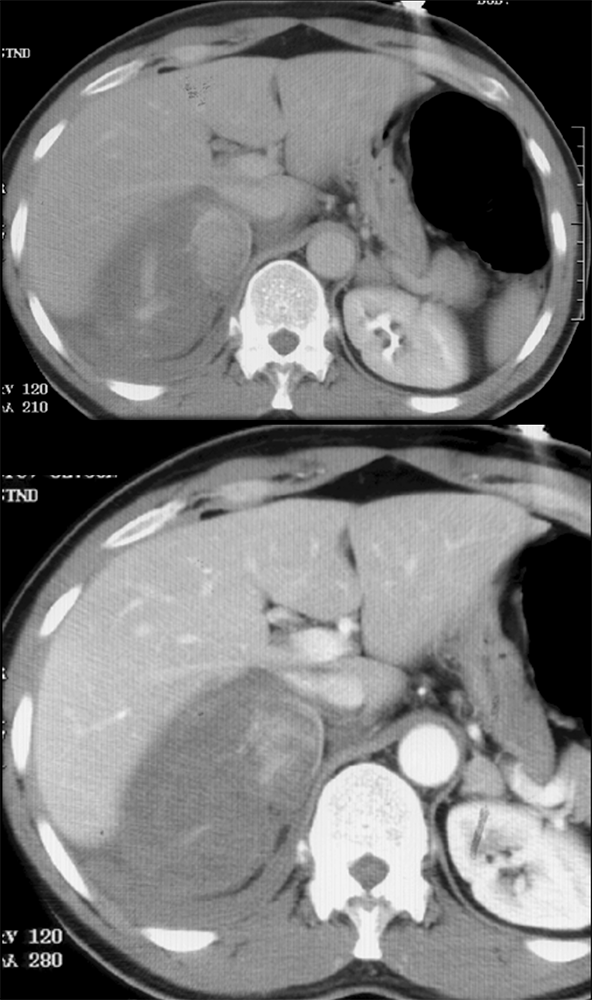 Large Adrenal Masses