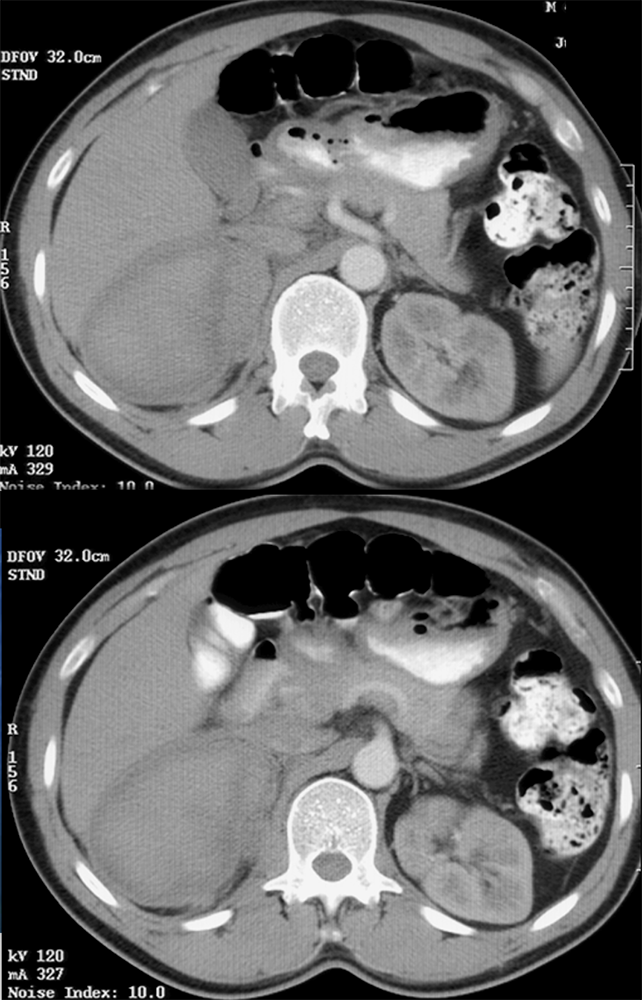 Perirenal/Adrenal Bed Hematoma-Primary Adrenal Carcinoma