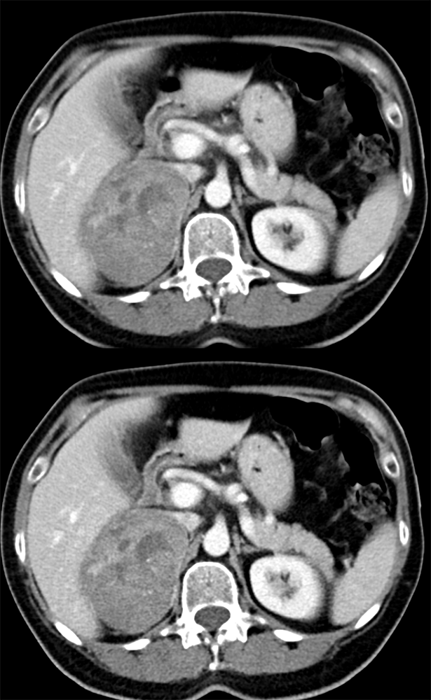 Bleed in a Pheochromocytoma