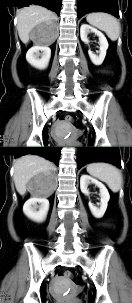 Large Adrenal Masses