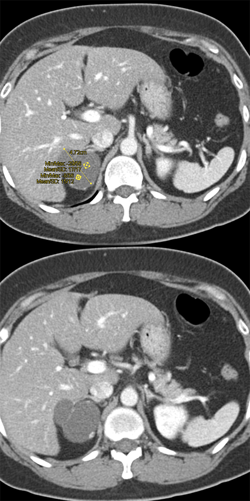 Evaluate Adrenal Mass