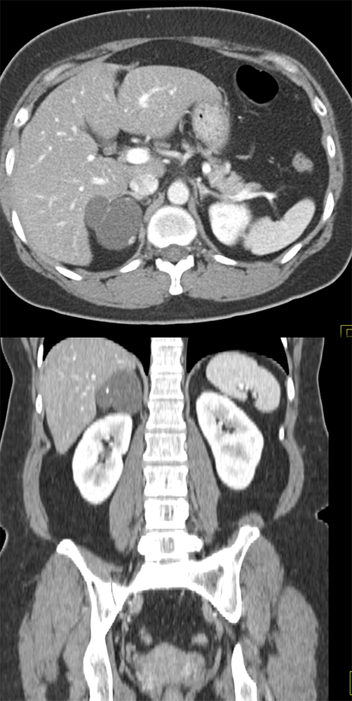 Large Adrenal Masses