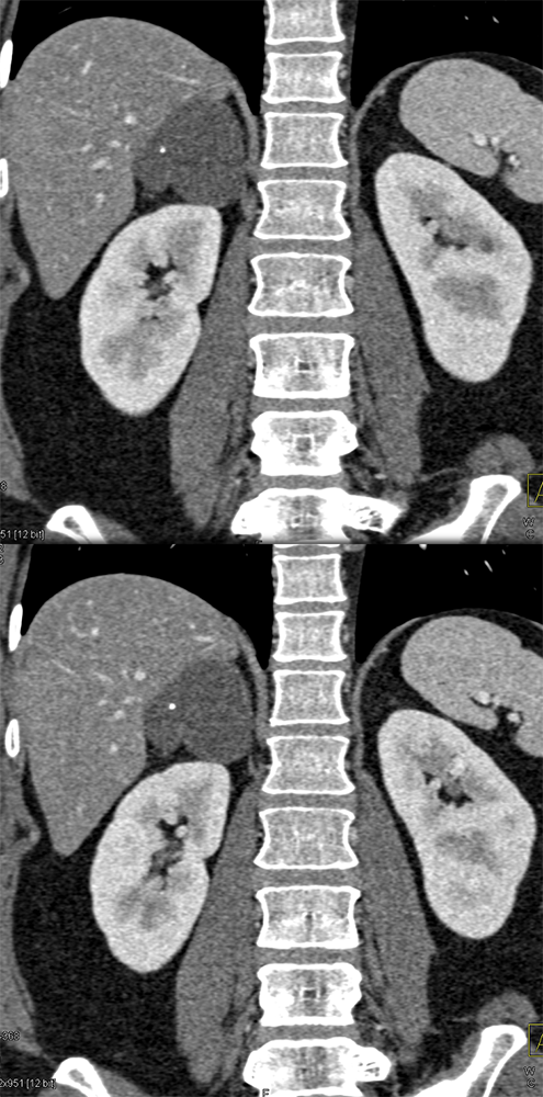 Large Adrenal Masses