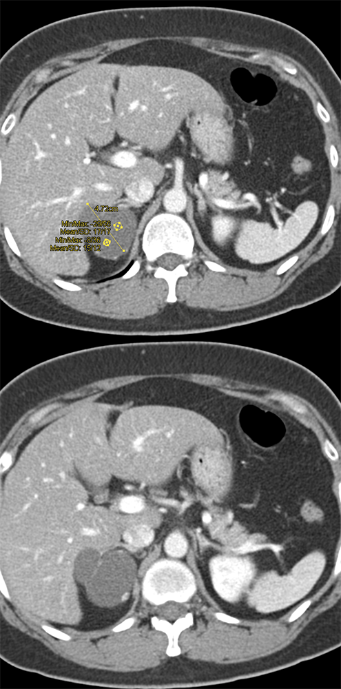 Adrenal Lymphangioma