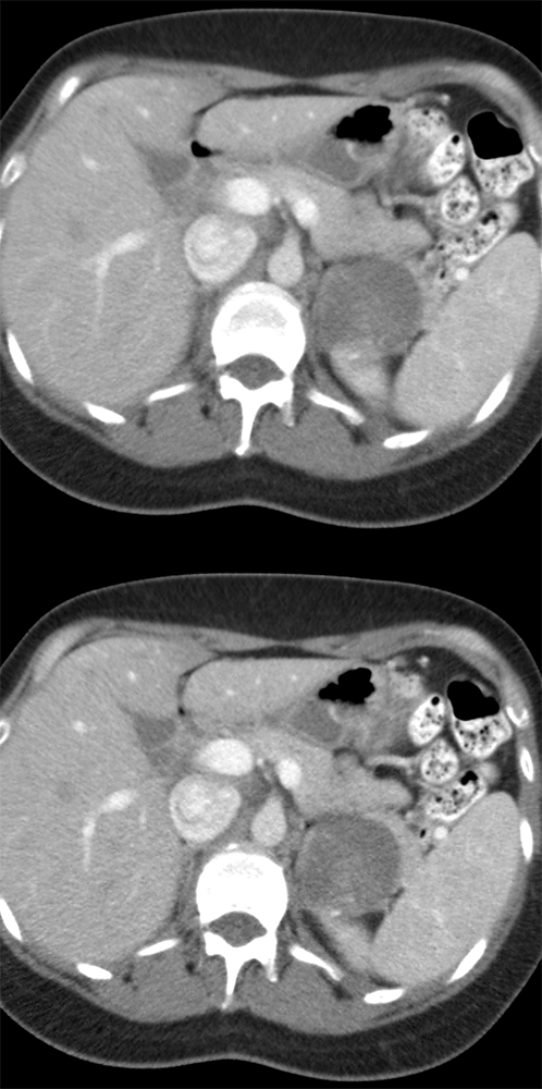 Large Adrenal Masses