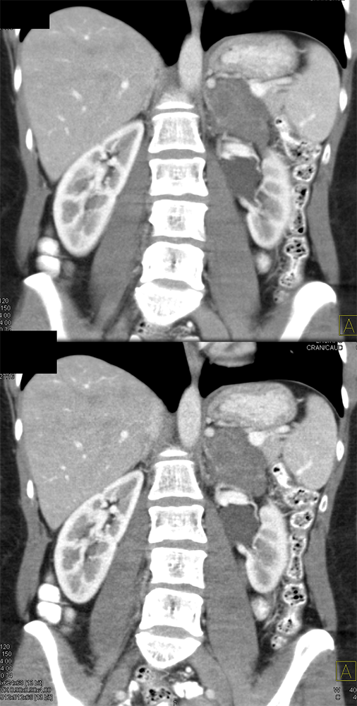 Large Adrenal Masses