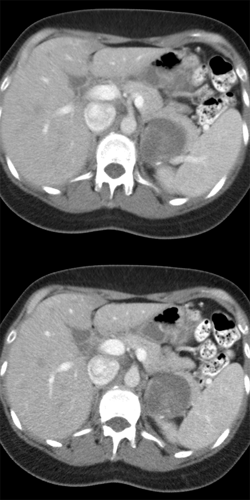 Ganglioneuroma Let Adrenal