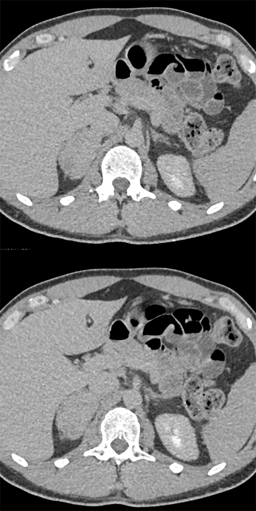 Large Adrenal Masses