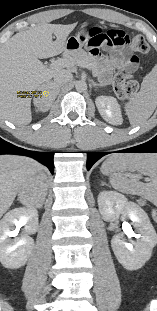 Large Adrenal Masses