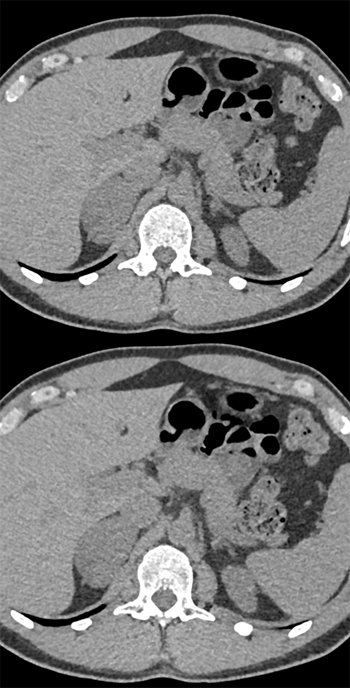 7cm Ganglioneuroma