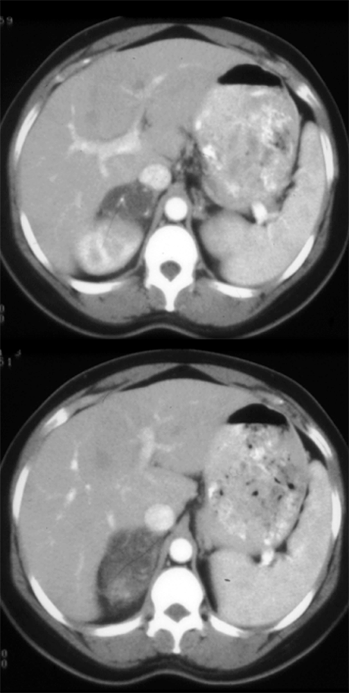 Adrenal Ganglioneuroma