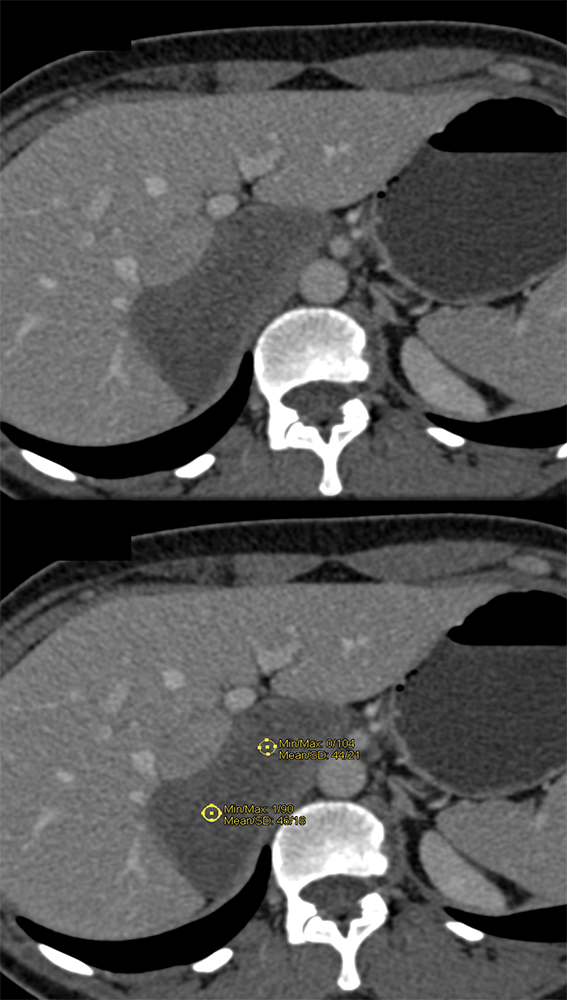 Large Adrenal Masses