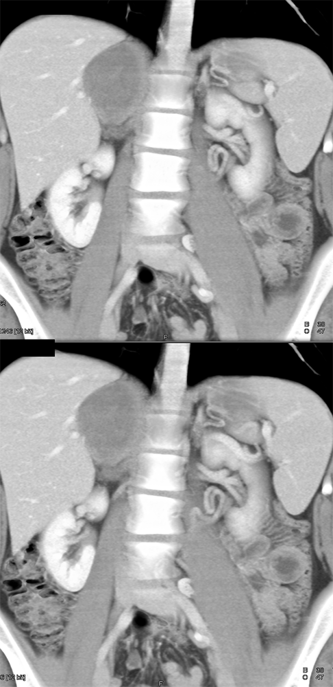 Large Adrenal Masses