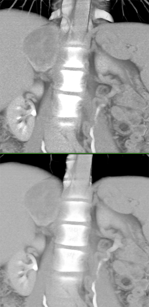 Large Adrenal Masses