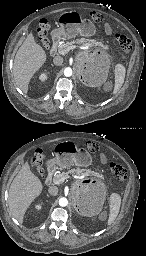 Large Adrenal Masses