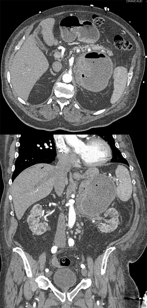 Large Adrenal Masses