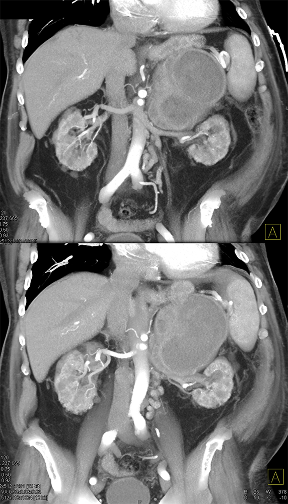 Large Adrenal Masses