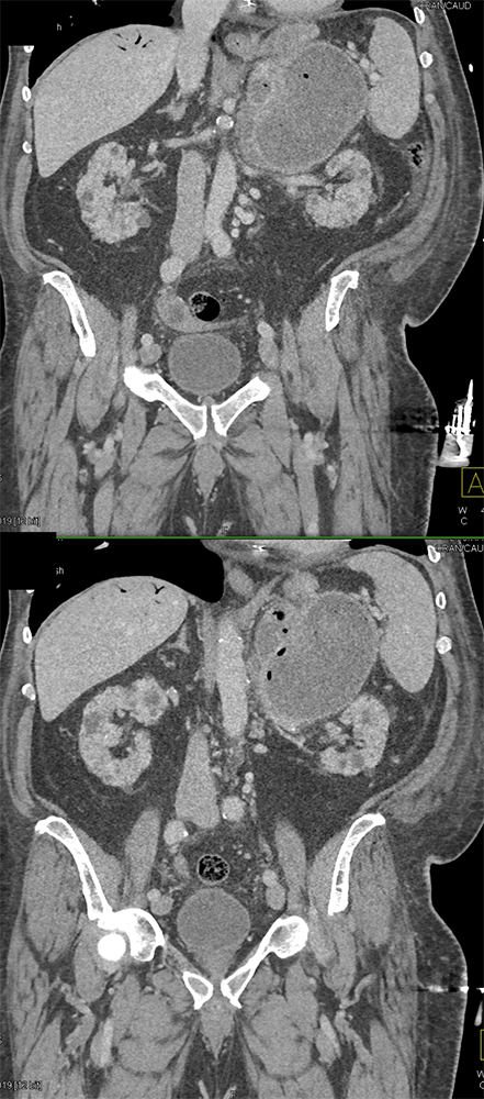 Large Adrenal Masses