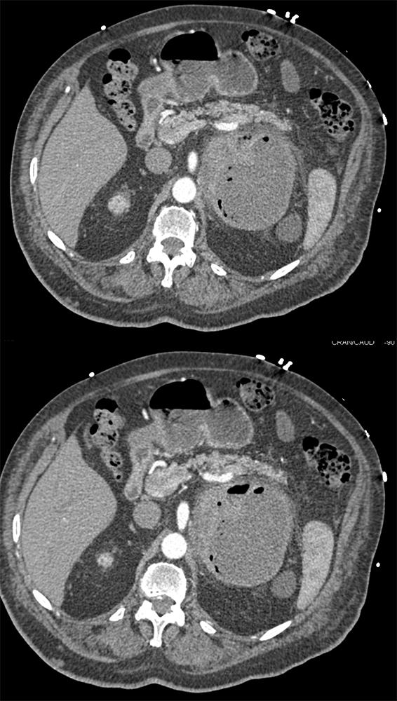 At Surgery was Adrenal Abscess