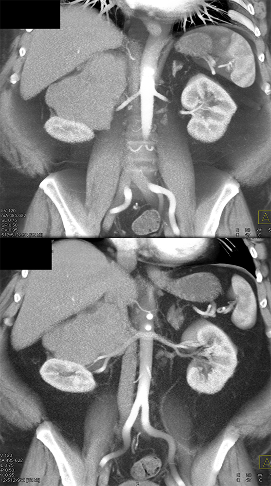 Leiomyosarcoma of the Adrenal