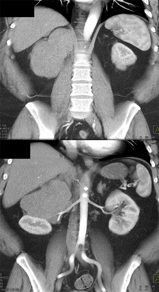 Large Adrenal Masses