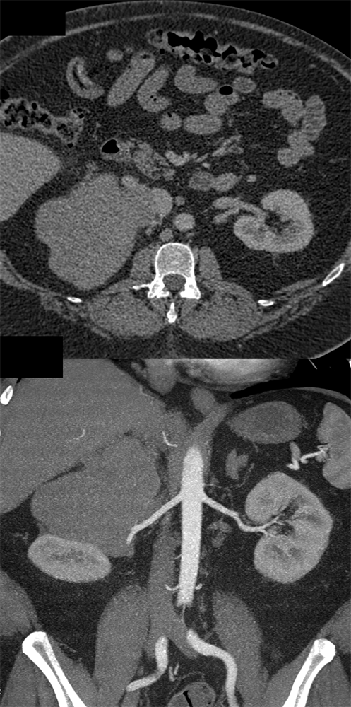 Large Adrenal Masses