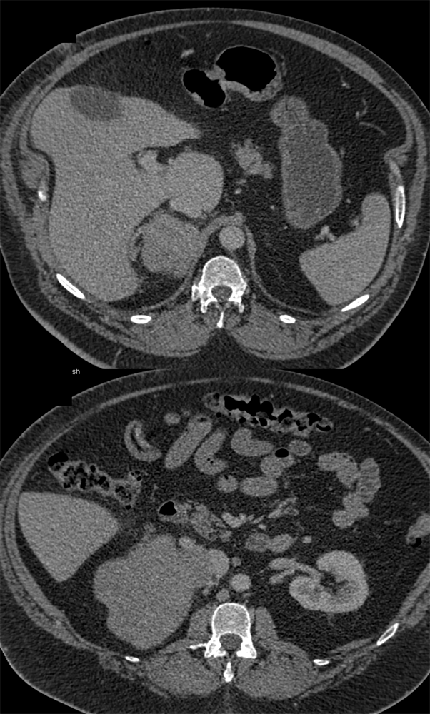 Large Adrenal Masses